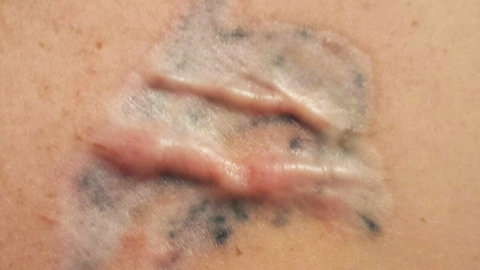 Montreal woman claims tattoo-removal treatment resulted in ...