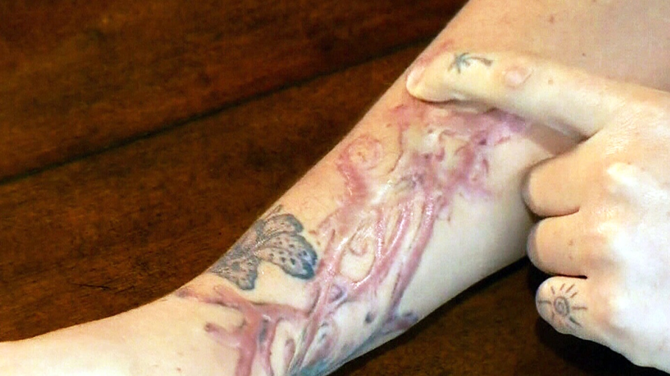 Montreal woman claims tattoo-removal treatment resulted in ...