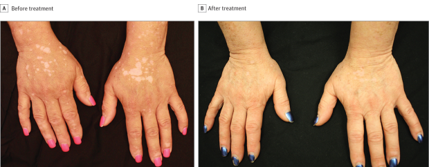 Hands before and after treatment for vitiligo