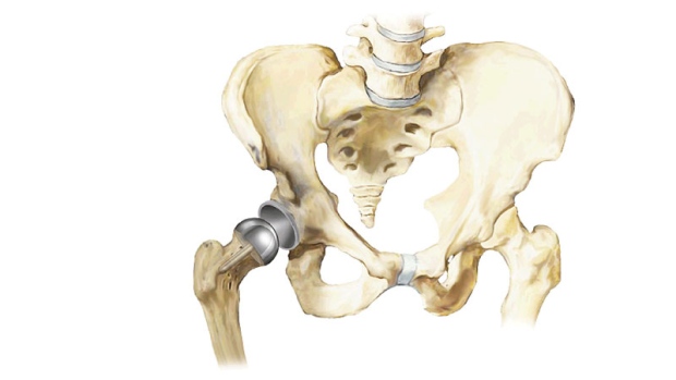 This image provided by Smith & Nephew shows the Birmingham Hip Resurfacing System, which is a metal cap fitted over a femoral bone, left, that will fit into a metal socket inserted in the pelvis. (AP Photo/Smith & Nephew)