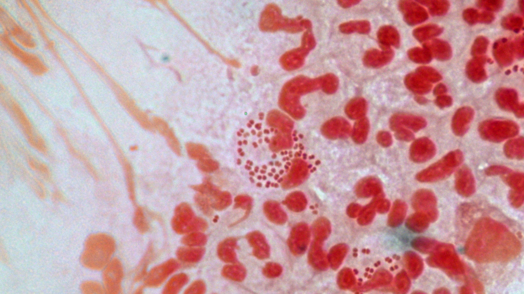 ‘Highly resistant’ gonorrhea on the rise in Canada, other countries: World Health Organization