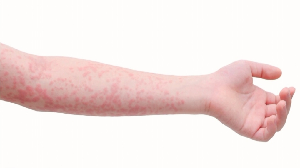 Measles case in Edmonton prompts exposure warning