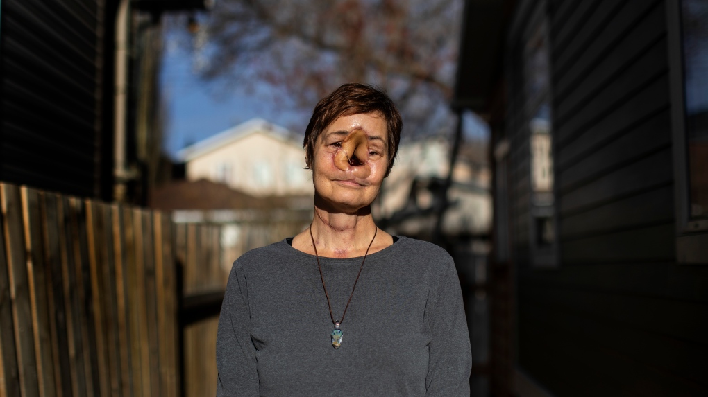 ‘Saya menunda hidup:’ Wanita yang menunda operasi di Alberta mengatakan kondisinya lebih buruk