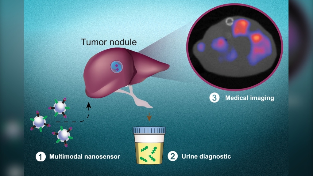 Multimodal nanosensors (1) are engineered to target and respond to hallmarks in the tumor microenvironment. The nanosensors provide both a noninvasive urinary monitoring tool (2) and an on-demand medical imaging agent (3) to localize tumor metastasis and assess response to therapy. (Liangliang Hao)