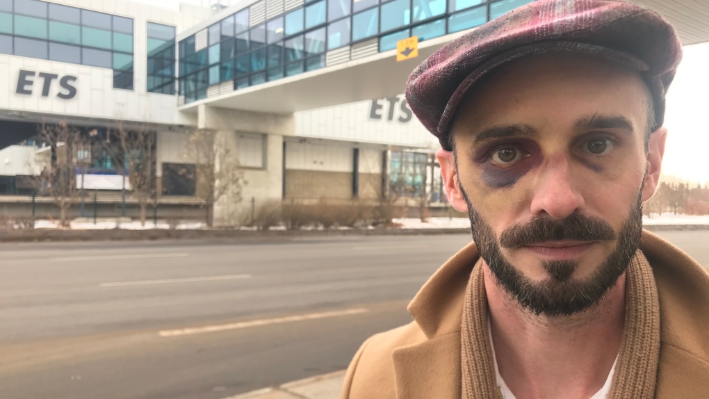 'Sucker punched me': Edmonton man describes transit assault, asks for more provincial help
