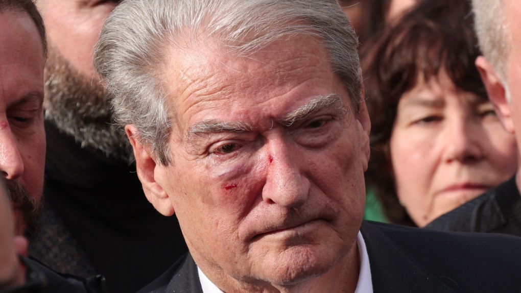 Sali Berisha, the leader of the Albanian opposition centre-right Democratic Party, injured, looks on after he has been attacked during an anti-government protest held near a summit of European Union leaders and their counterparts from the Western Balkans in the capital Tirana, Albania , on Dec. 6, 2022. (Franc Zhurda / AP) 