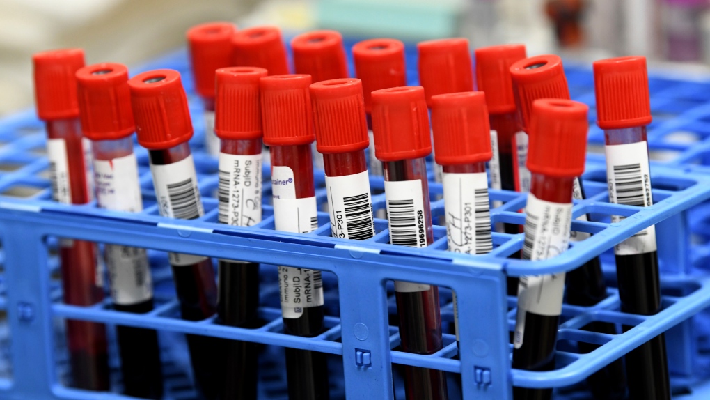 In this Wednesday, Sept. 2, 2020 file photo, blood samples wait to be processed in a lab at the University of Miami Miller School of Medicine. (AP Photo/Taimy Alvarez) 