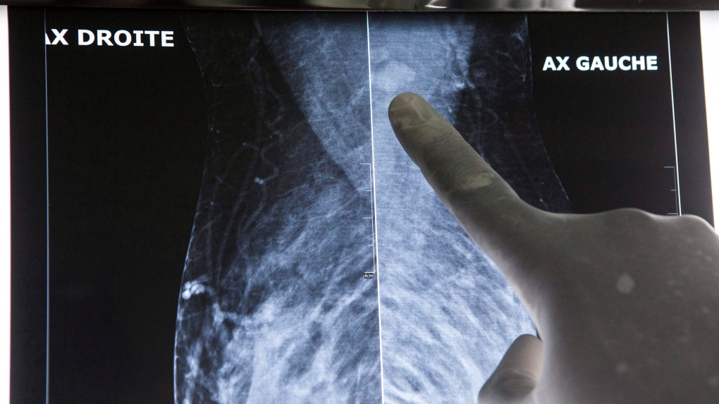 Il numero di screening per il cancro al seno è stato ridotto a 40 in Ontario, che ha ricevuto elogi da parte degli esperti sanitari locali