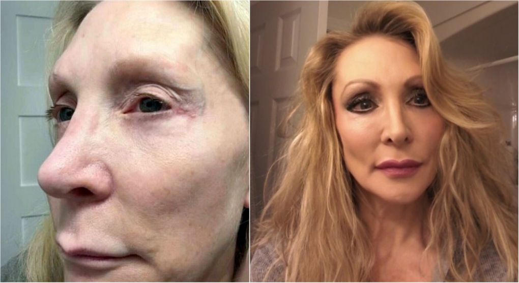 Ontario woman says $10K cosmetic eye procedure 'destroyed' her life