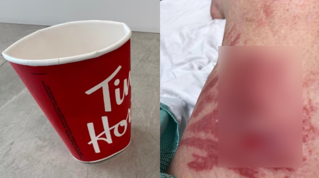 Woman suing Tim Hortons for $500K after hot tea spill left her 'disfigured'