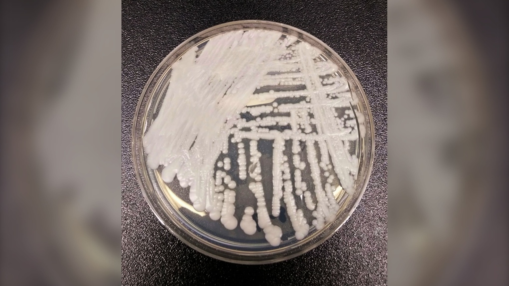 Superbug fungus cases in U.S. rose dramatically during pandemic