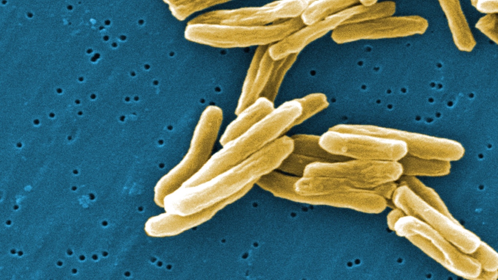 Tuberculosis outbreak declared in third Nunavut hamlet