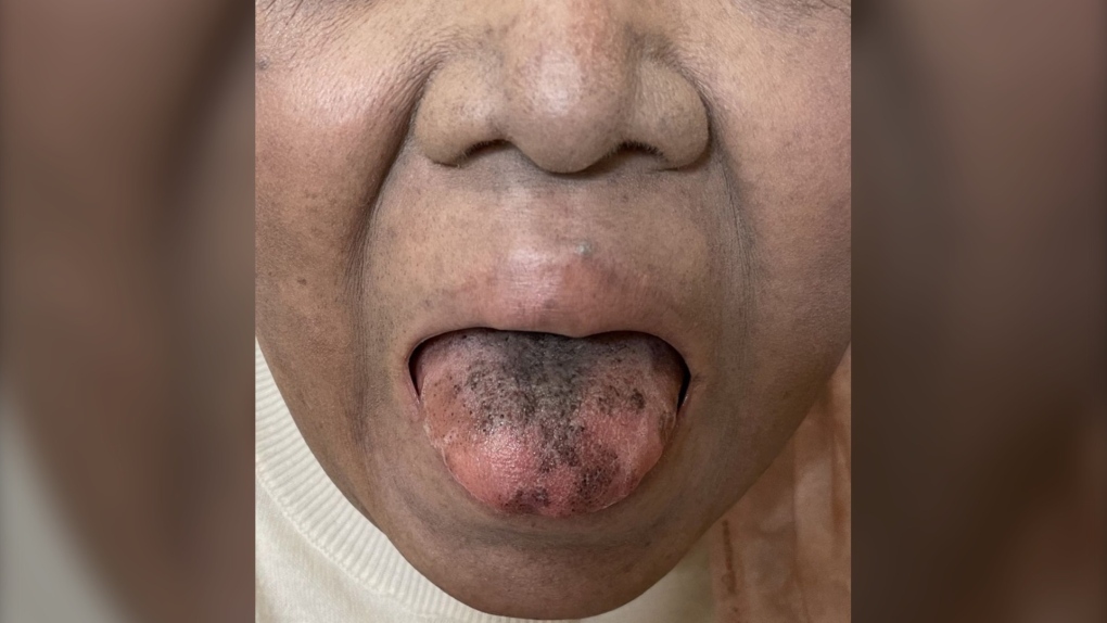 Black hairy tongue cured concurrently with respiratory infection   Cleveland Clinic Journal of Medicine
