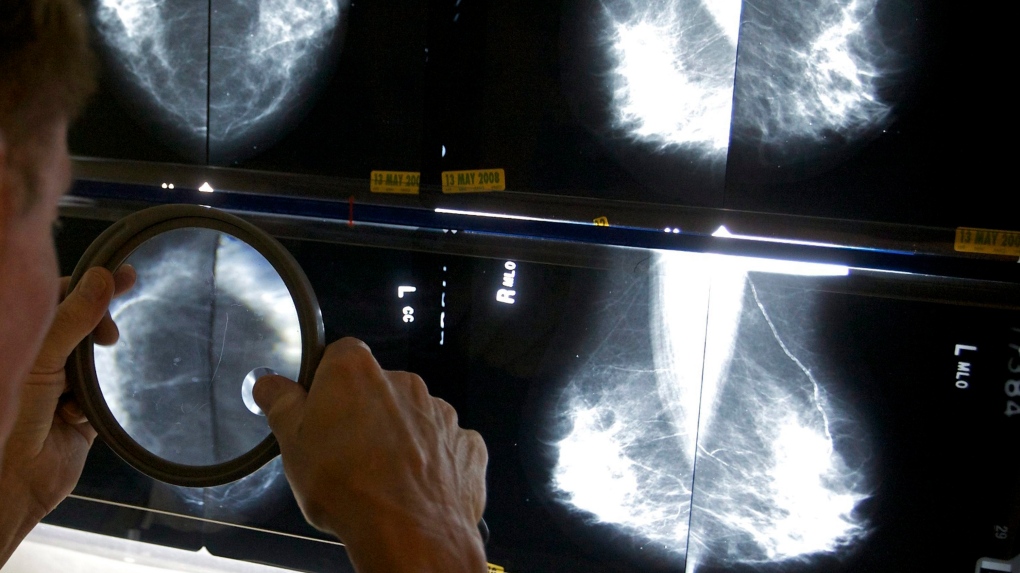 Should breast cancer screening start at age 40? Doctors, survivors call on Canada to follow U.S. lead
