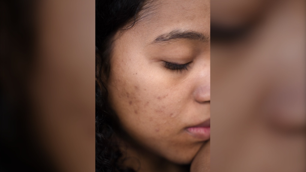Skin flare-ups? Here might be why acne is coming back: expert