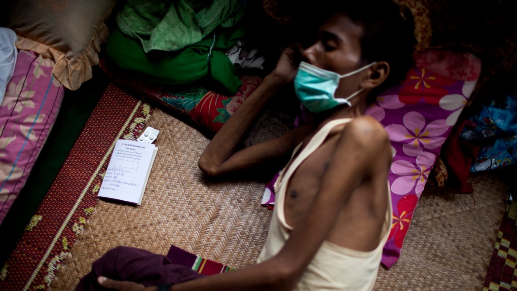 An HIV patient rest on a bed in Burma 