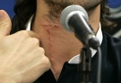 Florida Panthers hockey player Richard Zednik discusses his neck injury for the first time since the accident occurred during an NHL game in Buffalo last week, during a news conference in Sunrise, Fla., Thursday, Feb. 21, 2008. (AP / J. Pat Carter)