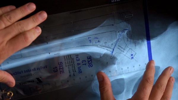 In 2003 file photo, a doctor holds a template of part of an artificial hip against an x-ray prior to performing a minimally invasive hip replacement surgery (AP Photo/Charlie Riedel, File)