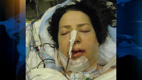 Cassandra Walde needed extensive dental work after throwing herself out of a third-storey window after smoking salvia. Dec. 14, 2010. (CTV)