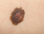 A melanoma that was misdiagnosed as a benign lesion by three out of four smart phone apps tested in study is shown in a handout photo. (THE CANADIAN PRESS/HO-University of Pittsburgh Department of Dermatology)