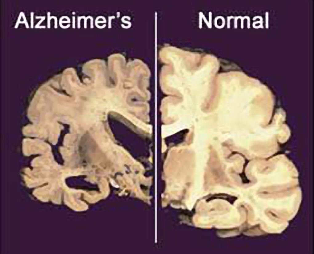 Normal brain, right, and one damaged by Alzheimers