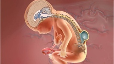 Part of the spinal cord and spinal nerves, usually encased in a sac, protrude through an opening in the back and is exposed to the amniotic fluid. The brainstem (hindbrain) descends, or herniates, into the spinal canal in the neck and blocks the flow of cerebrospinal fluid. This can cause a damaging buildup of fluid in the brain called hydrocephalus