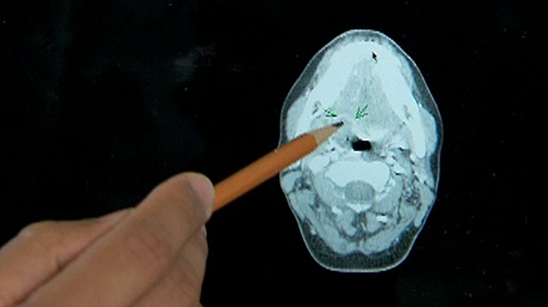 A tumor in a tonsil is shown on a CT scan.