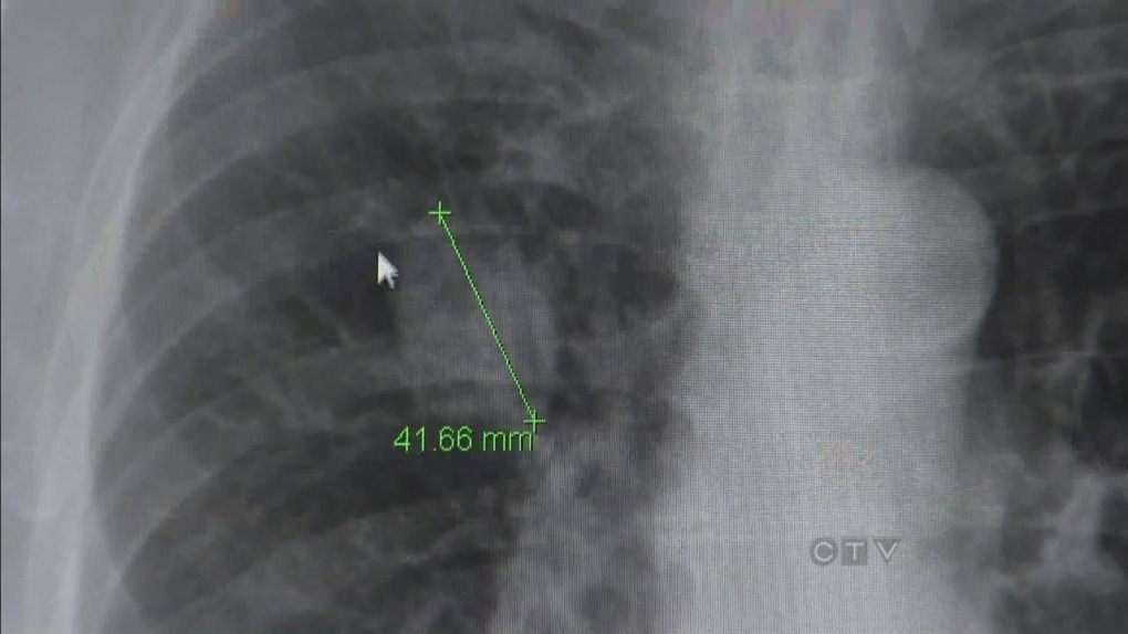CTV BC: Beating the clock on lung cancer