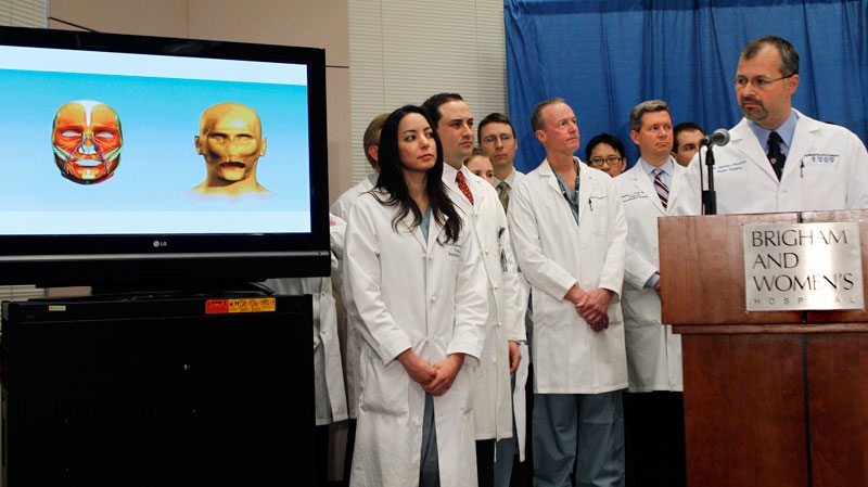 Plastic surgeon Dr. Bohdan Pomahac, far right, refers to a graphic during a news conference at Brigham and Women's Hospital in Boston Monday, March 21, 2011 regarding a face transplant he and his team performed. (AP / Elise Amendola)