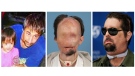 This three-photo combination shows Dallas Wiens, the recipient of the first full face transplant in the United States. On the right, a 2008 Wiens family photo provided by Brigham and Women's Hospital, shows Wiens with his daughter Scarlette prior to an electrical accident that disfigured his face; centre, a December 2010 file photo provided by Parkland Health and Hospital System in Dallas, and released by Brigham and Women's Hospital in Boston, shows Wiens prior to receiving a full face transplant during the week of March 14, 2011; and left, shows Wiens as he takes questions from members of the media during a news conference at Brigham And Women's Hospital, in Boston, Monday, May 9, 2011.
