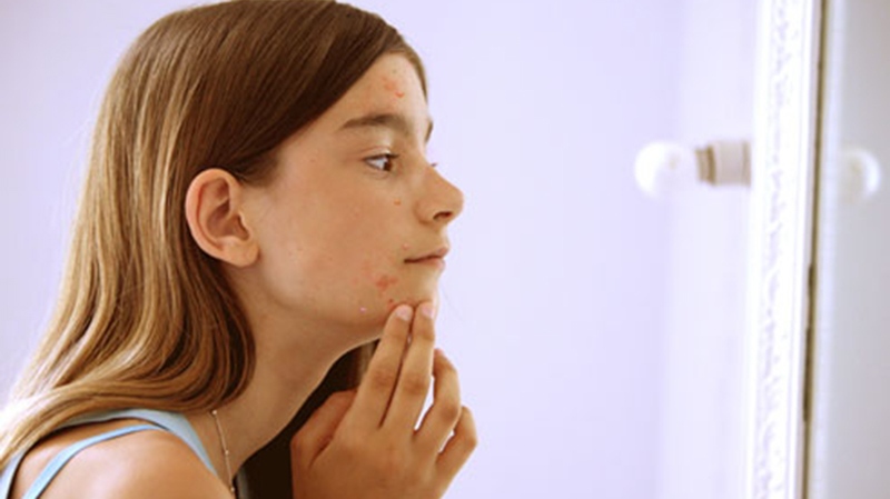 While it's highly common for teens to have breakouts, more children are also suffering from the skin condition.