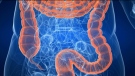 Research and treatment centres across the country are coming together to form Canada's first national network dedicated to Crohn's disease and colitis, the two main forms of inflammatory bowel disease.