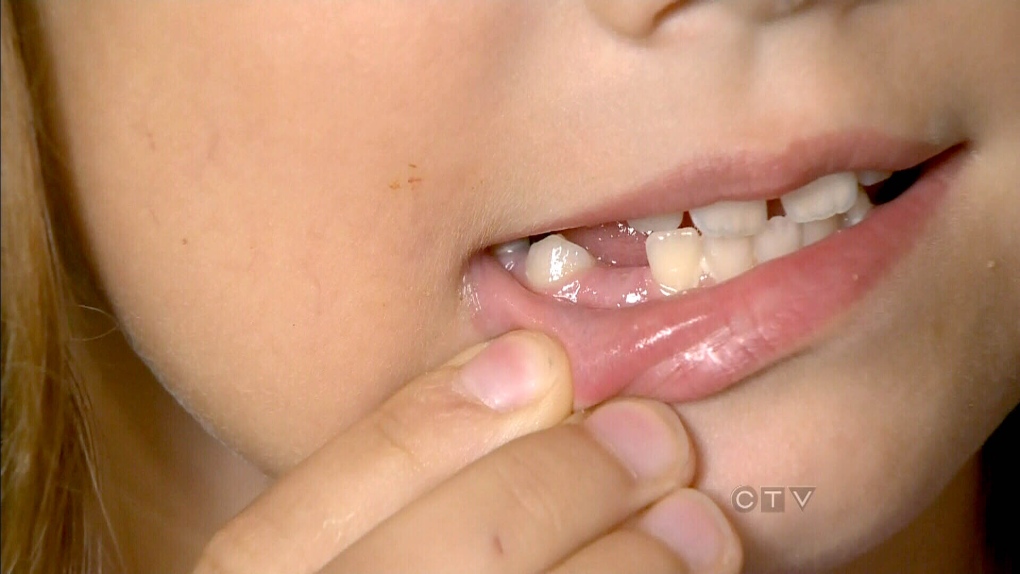 Child missing a tooth
