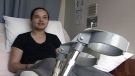 Lauren Gerro, 27, broke both her legs when a tree fell on top of her during a fierce wind storm in April. 