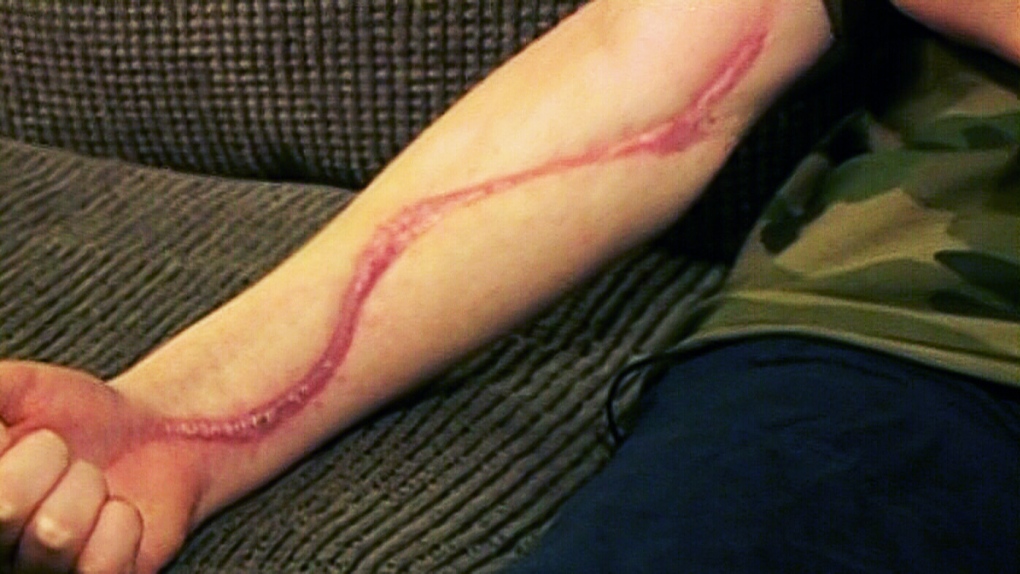 rattlesnake bite marks