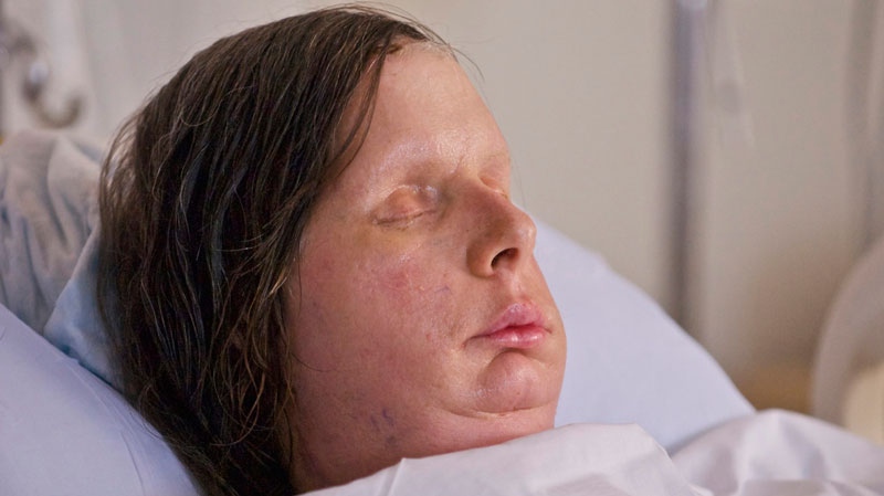 In this undated photo provided by Brigham and Women's Hospital, Charla Nash is seen after her May, 2011, face transplant at the hospital.(AP / Brigham and Women's Hospital, Lightchaser Photography)