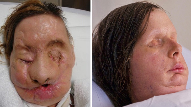 Chimpanzee attack victim Charla Nash is seen after the attack, left, and post-face transplant surgery, right. (Brigham and Women's Hospital, Lightchaser Photography)