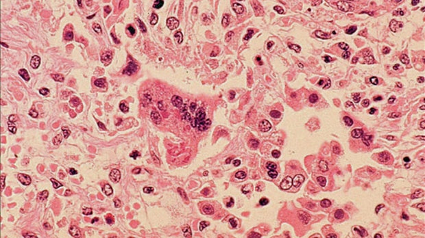 Ontario infant tests positive for measles