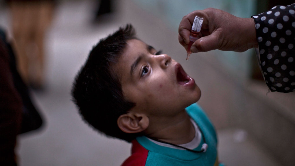 Polio-like illness in California