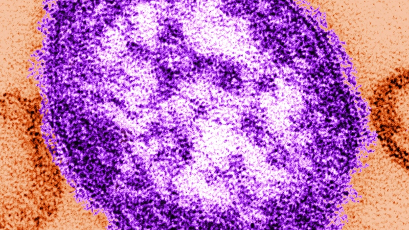 Alberta Health Services issues measles alert in Calgary