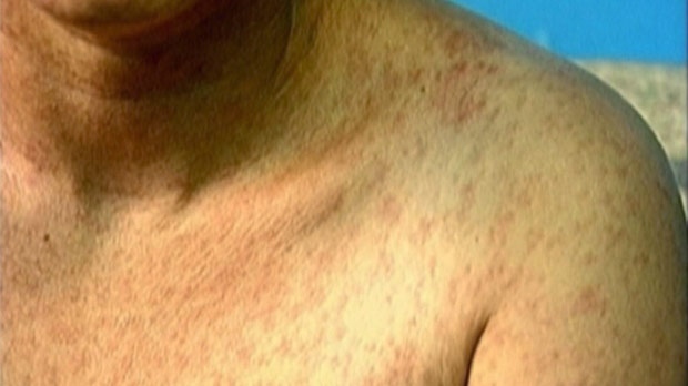Measles rash on a man's shoulder