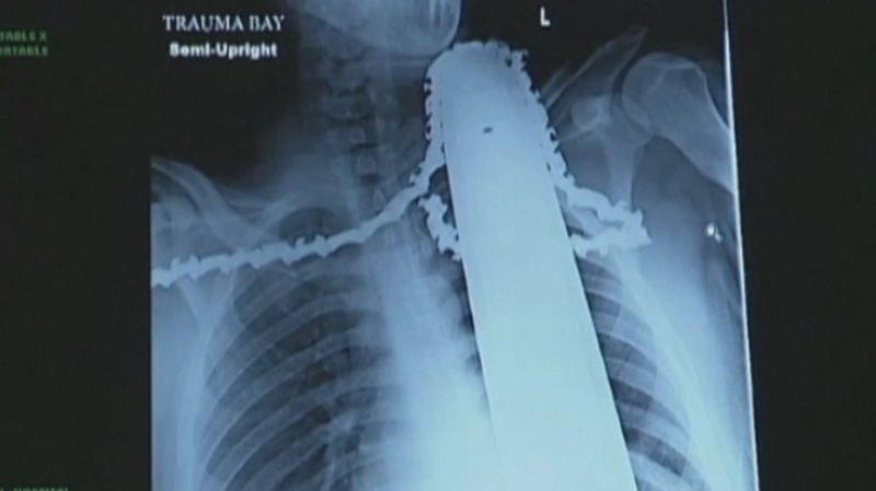 chainsaw accident neck