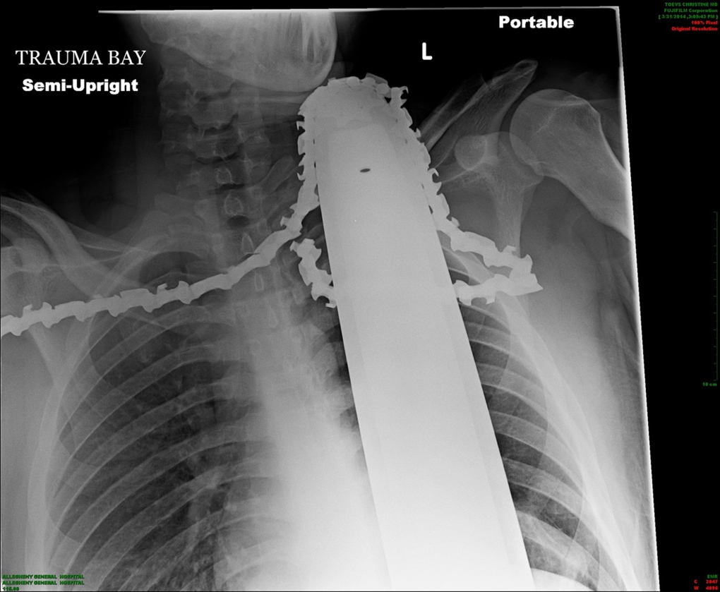 Man gets chainsaw stuck in his neck