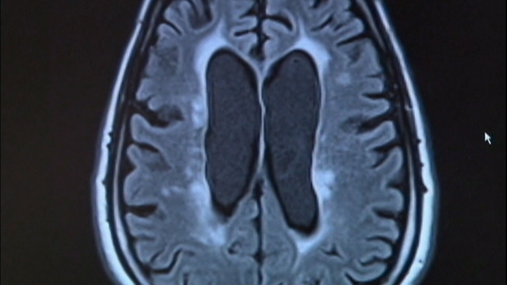 CTE found in brain of young football player