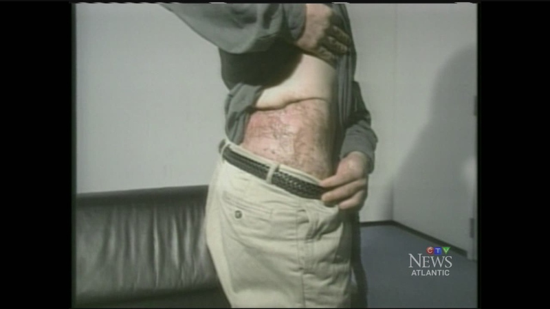 CTV Atlantic: Case of flesh-eating disease