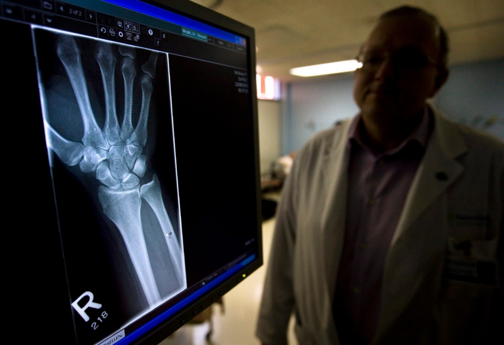 X-ray of broken wrist