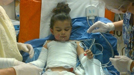 Girl recovers from burns after shirt catches on fire