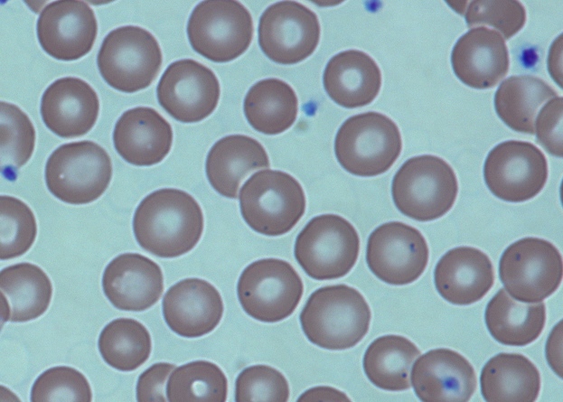 Sickle cell disease - red blood cells