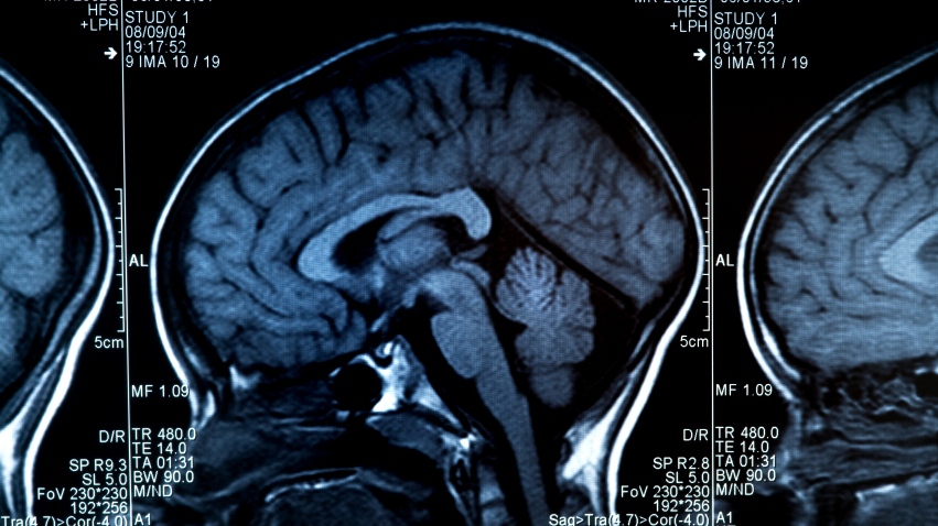 Online test for Alzheimer's: Measuring your cognitive health