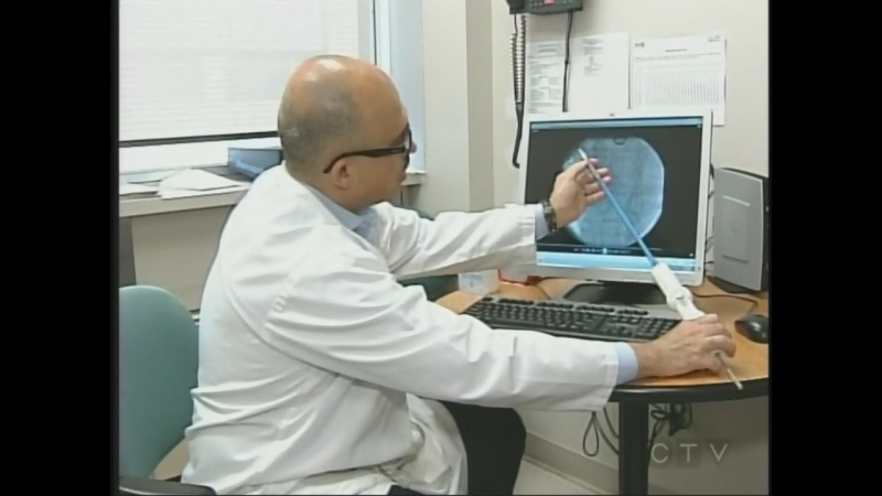 Heart surgeon Dr. Bob Kiaii discusses the use of the Acurate Ta to treat narrowed heart valves at the London Health Sciences Centre in London, Ont. on Thursday, July 17, 2014. (Chuck Dickson / CTV London)
